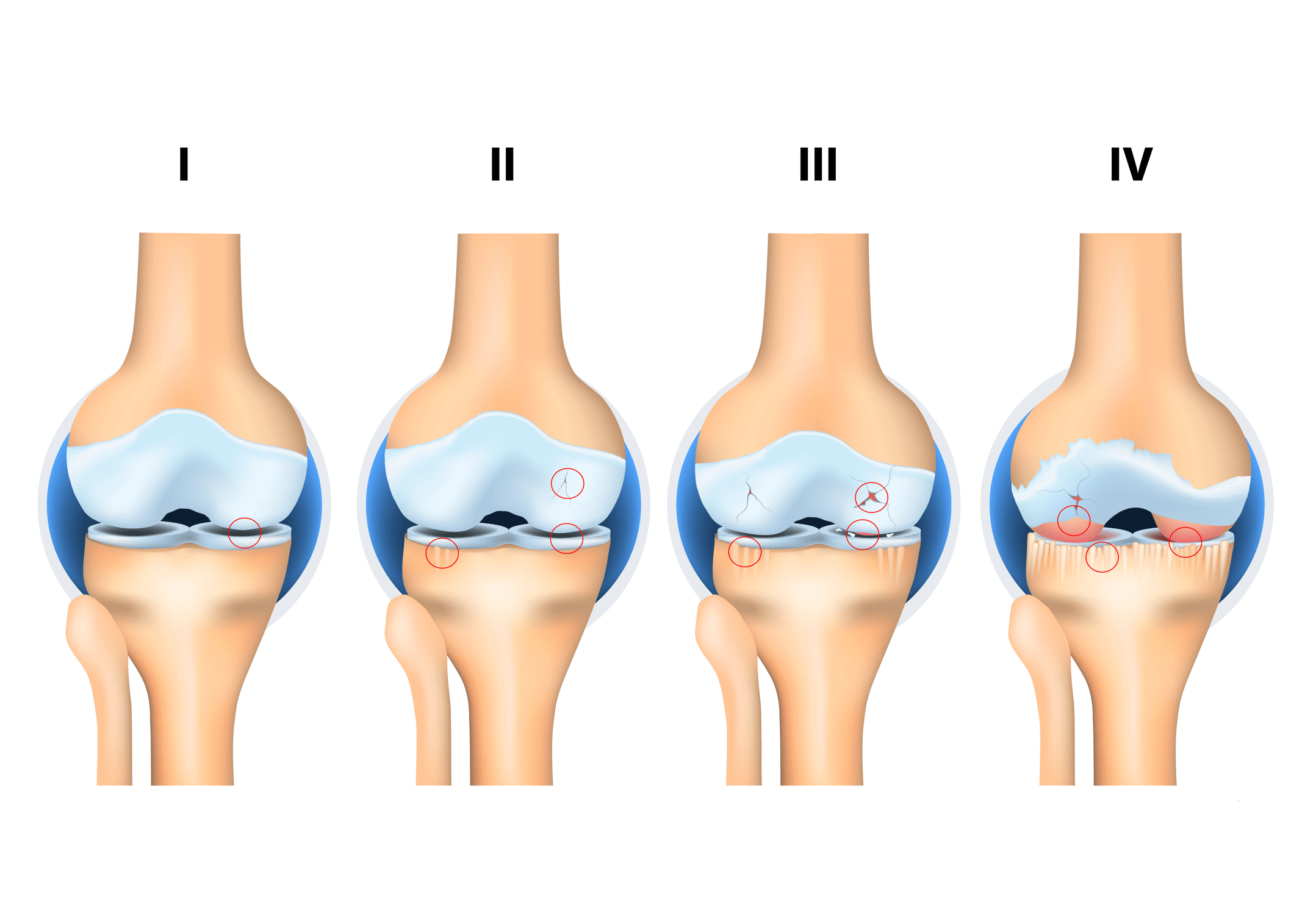 gonarthrosis