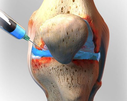 artroza 2. stupnja metoda liječenja koljena