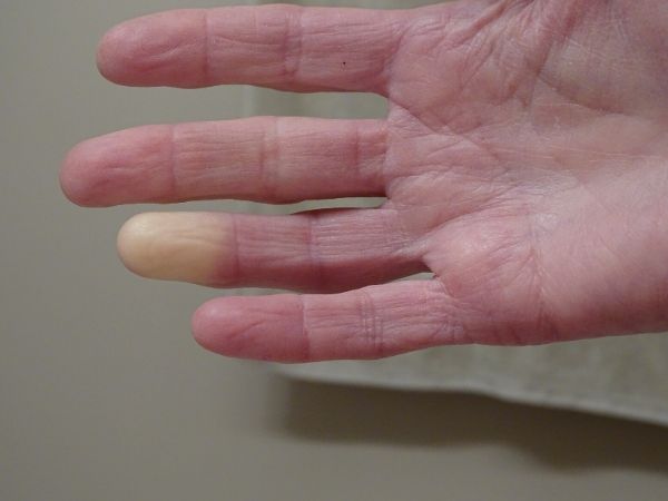rejnoov sindrom prsti