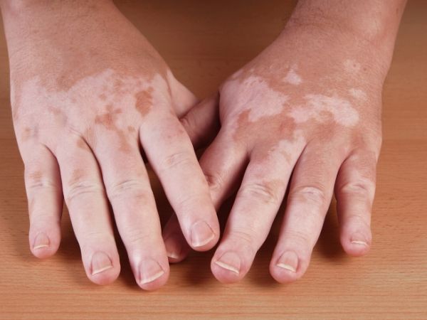 vitiligo