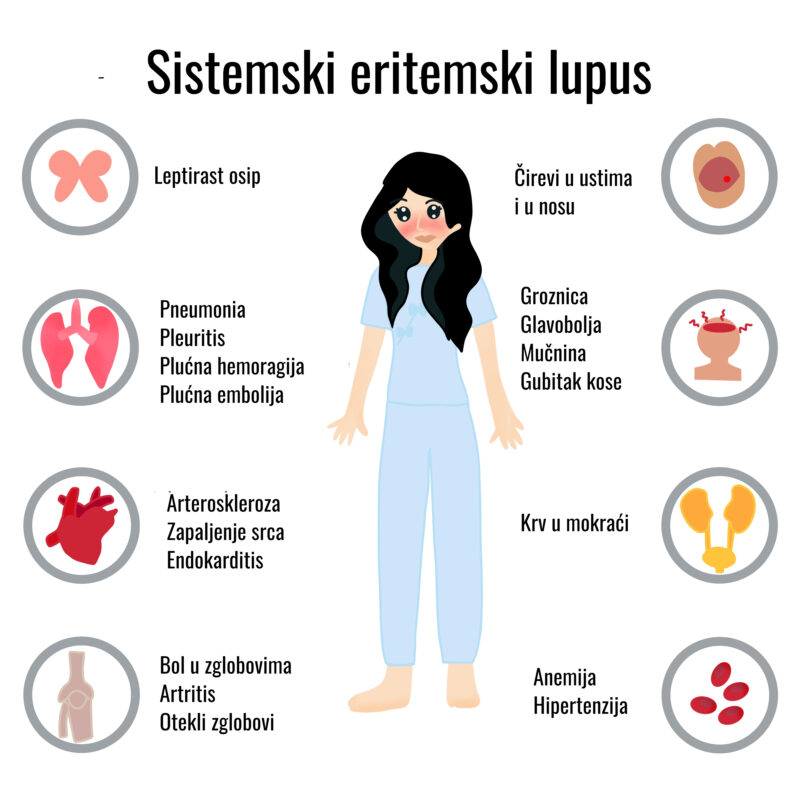 sistemski lupus